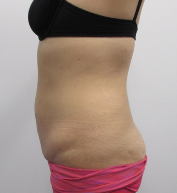 Tummy Tuck before and after - before