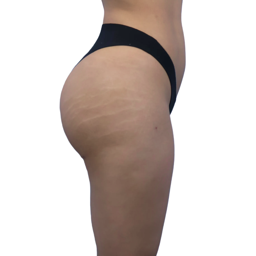 Bbl before and after - after