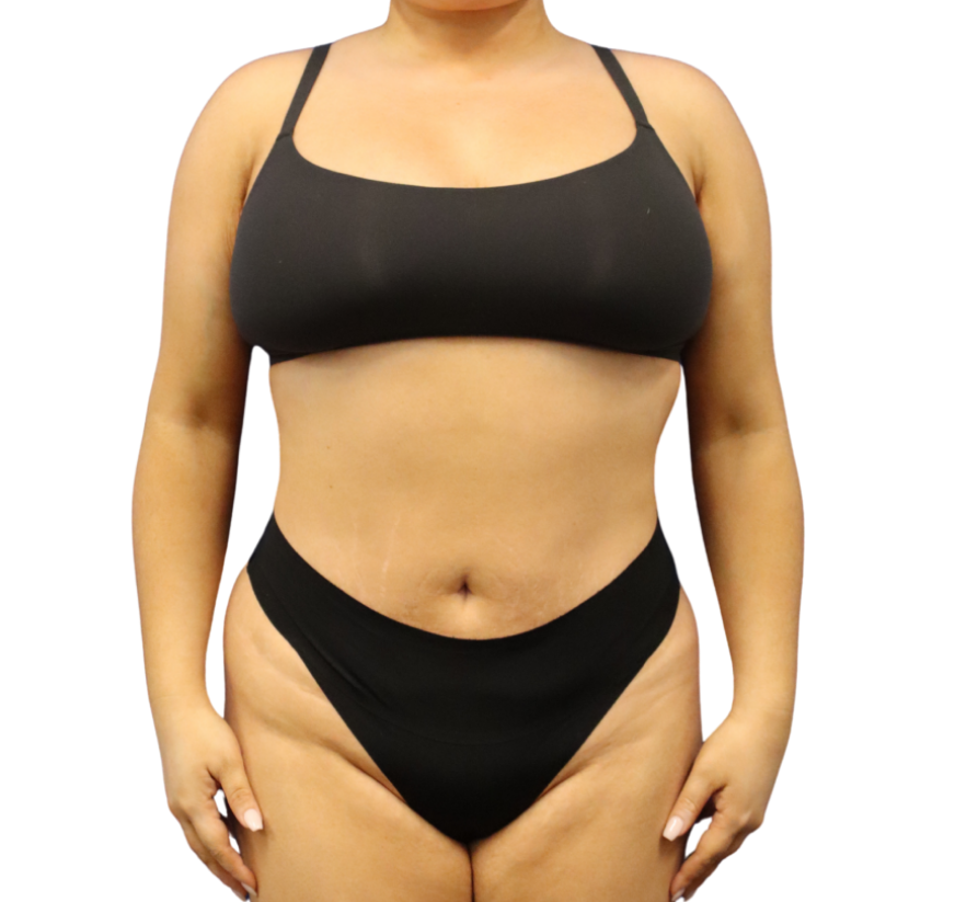 Tummy Tuck before and after - after