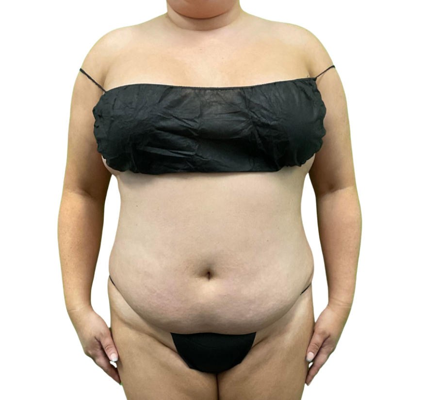 Tummy Tuck before and after - before