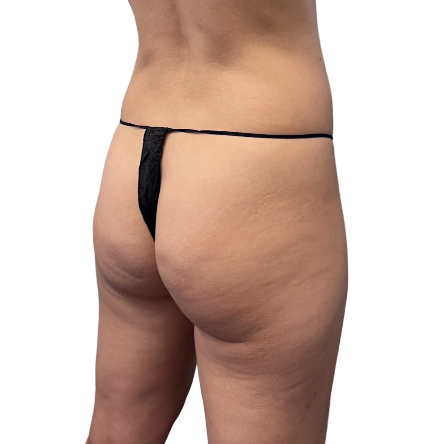 Bbl before and after - before