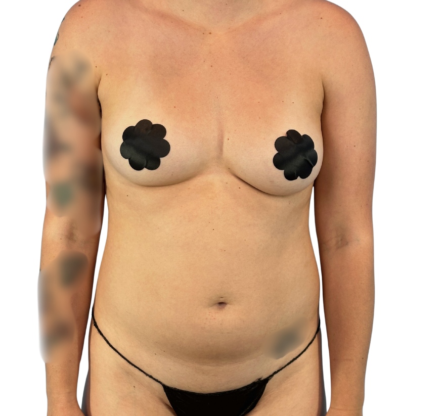 Mommy Makeover before and after - before