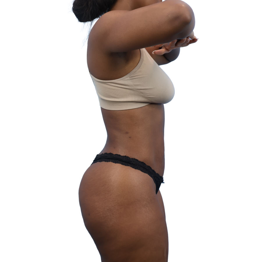 Tummy Tuck before and after - after