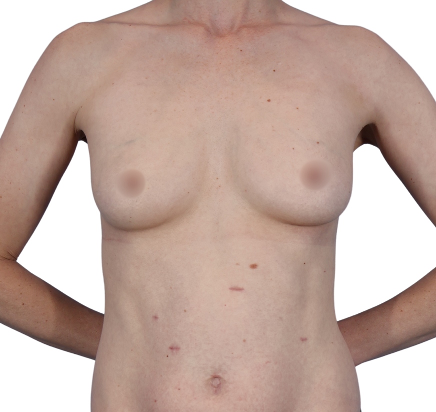 Breast Augmentation before and after - before