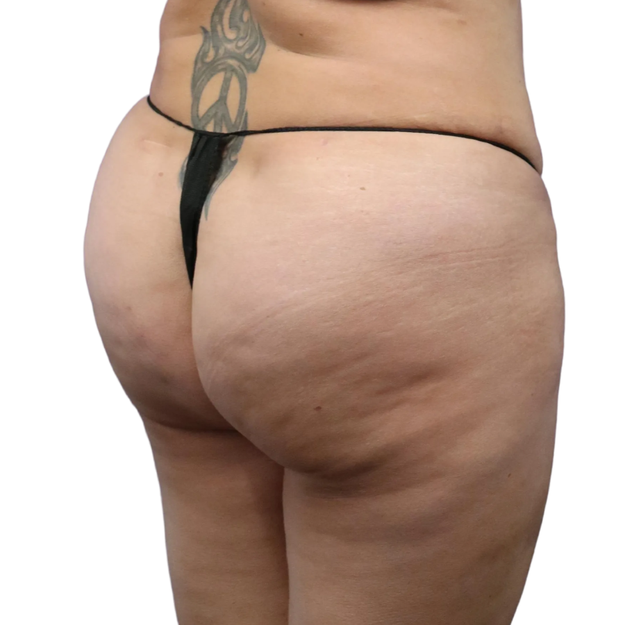 Bbl before and after - after