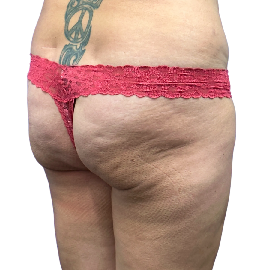Bbl before and after - before