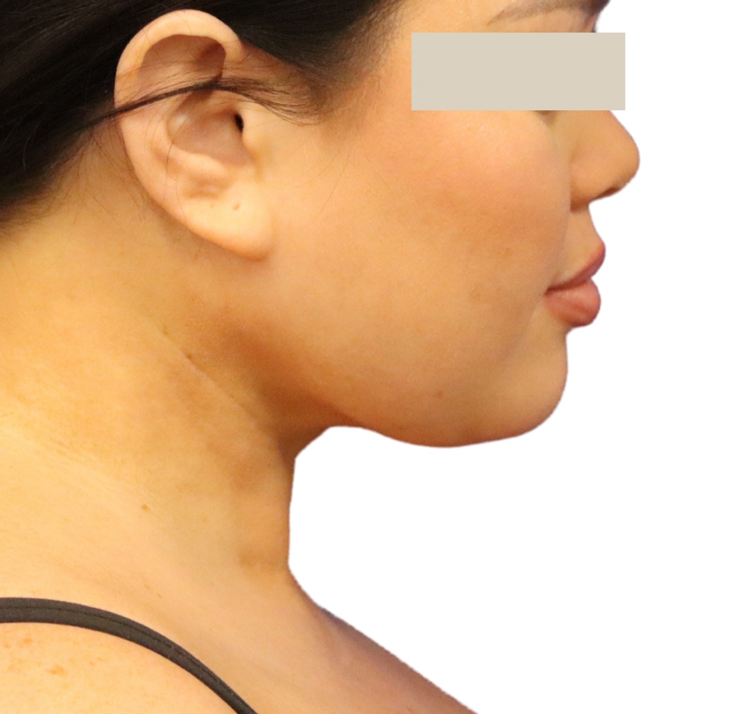 Liposuction before and after - after