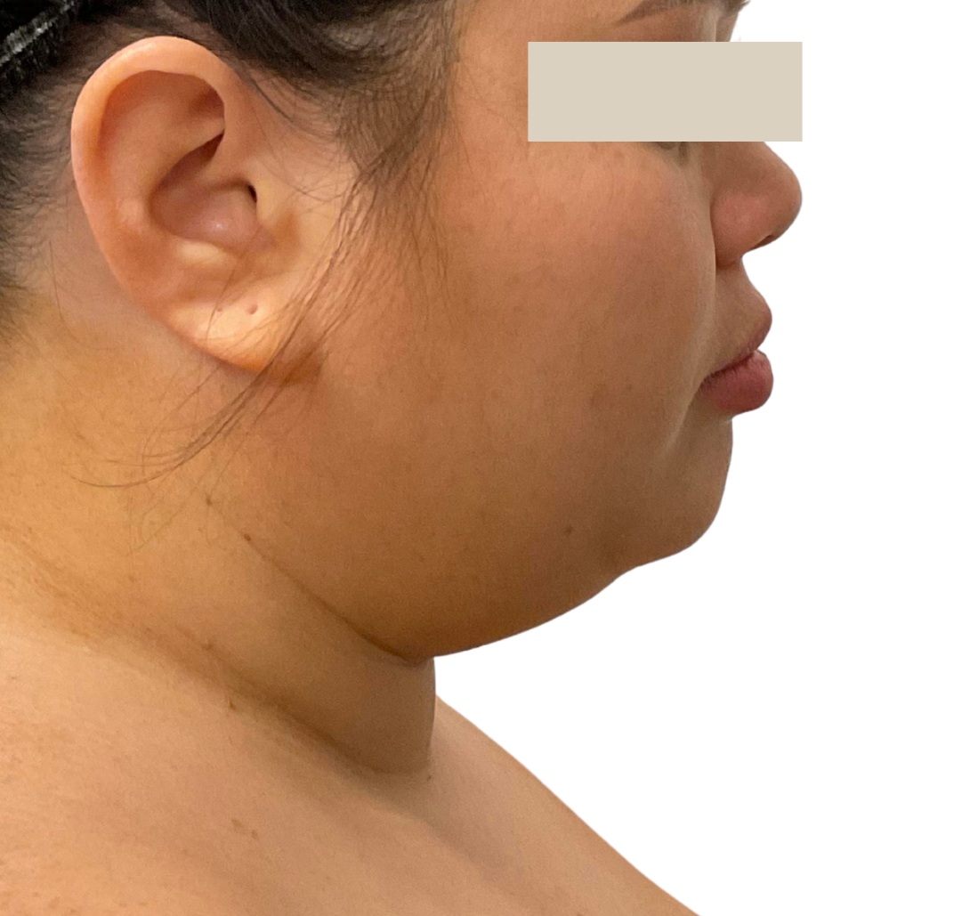Liposuction before and after - before