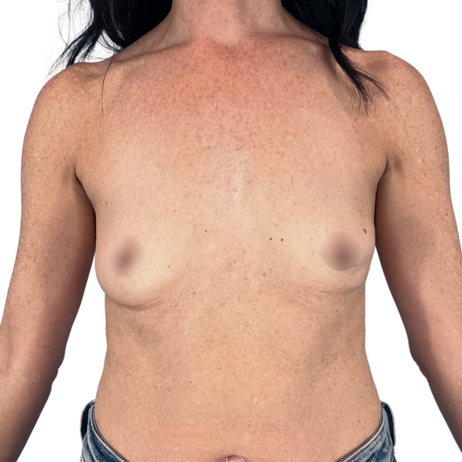 Breast Augmentation before and after - before