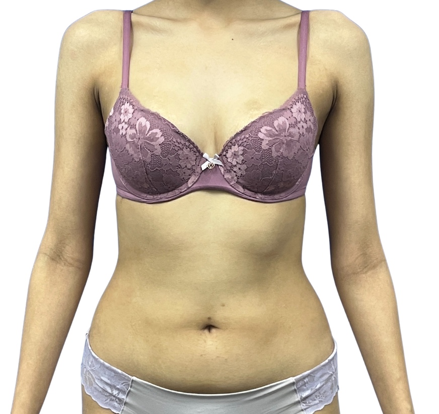 Tummy Tuck before and after - before