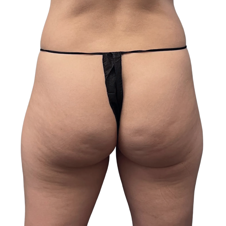 Bbl before and after - before