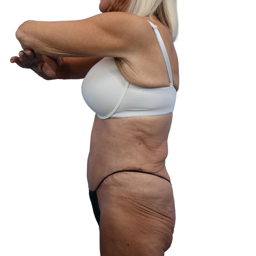 Tummy Tuck before and after - after