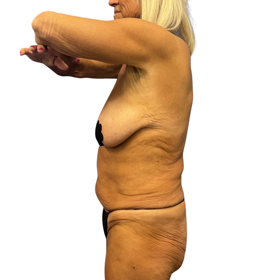 Tummy Tuck before and after - before