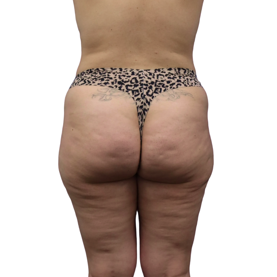 Bbl before and after - before