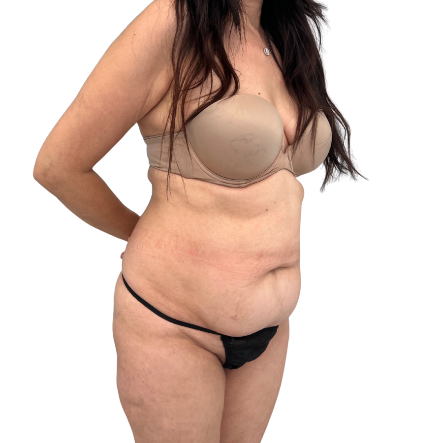 Tummy Tuck before and after - before