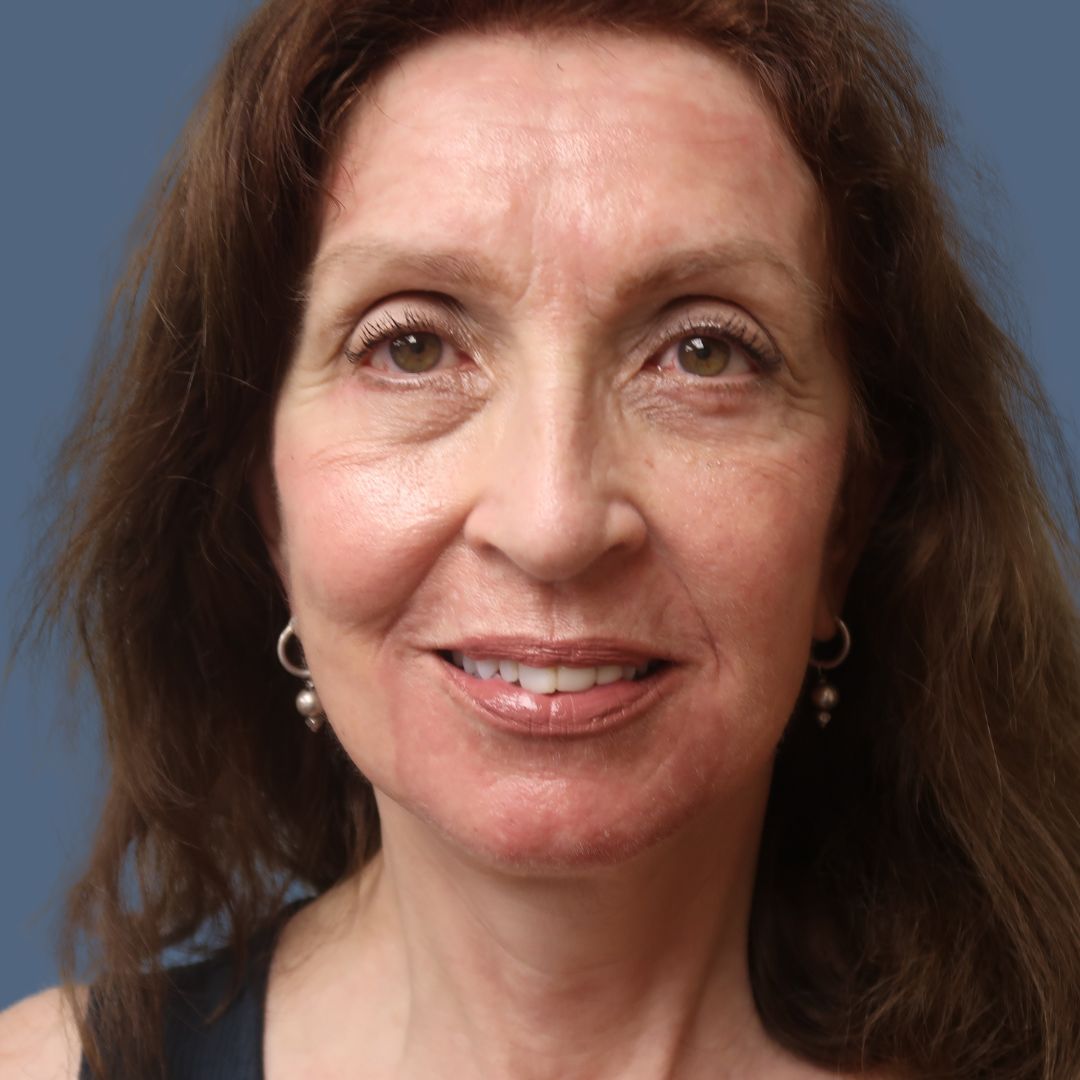 Facelift after — Dr. Enrique Armenta