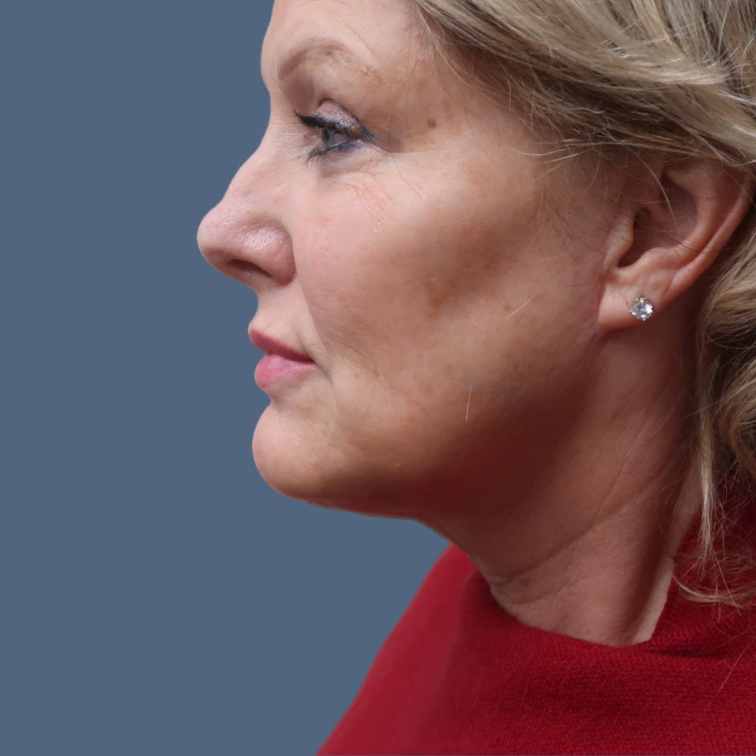Facelift after — Dr. Enrique Armenta