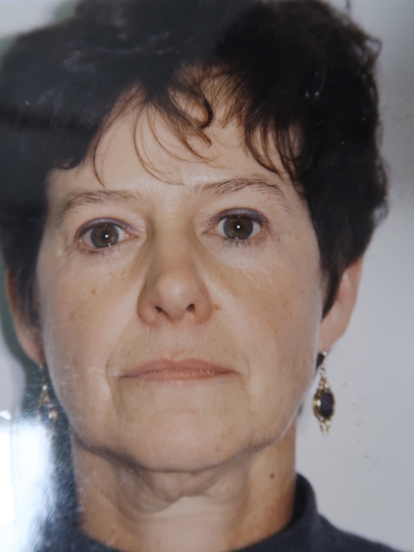 Facelift before — Dr. Enrique Armenta
