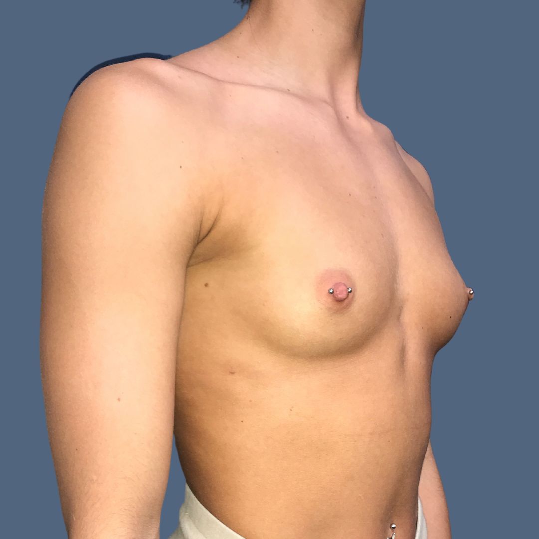 Breast Augmentation before — Dr. Enrique Armenta