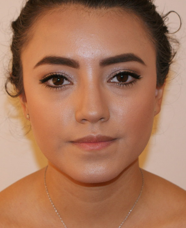 Rhinoplasty before and after - after