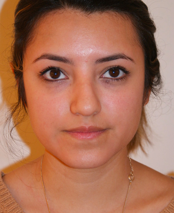 Rhinoplasty before and after - before