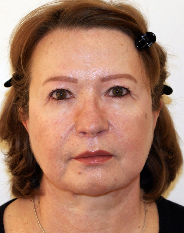 Brow Lift before and after - after