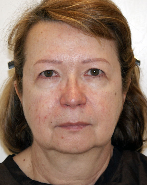 Brow Lift before and after - before