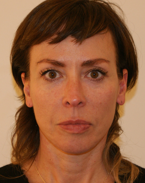 Face and Neck Lift before and after - after