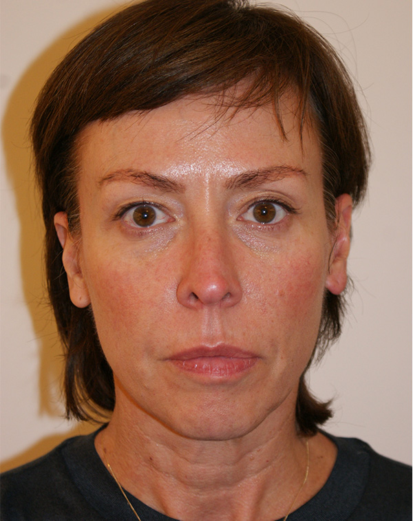 Face and Neck Lift before and after - before