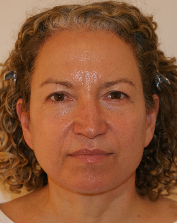 Facial Fat Transfer before and after - after