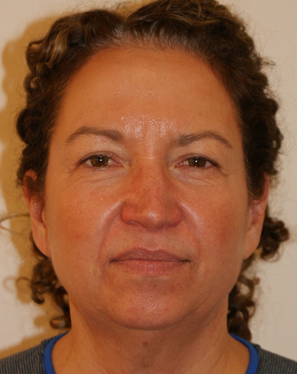 Facial Fat Transfer before and after - before