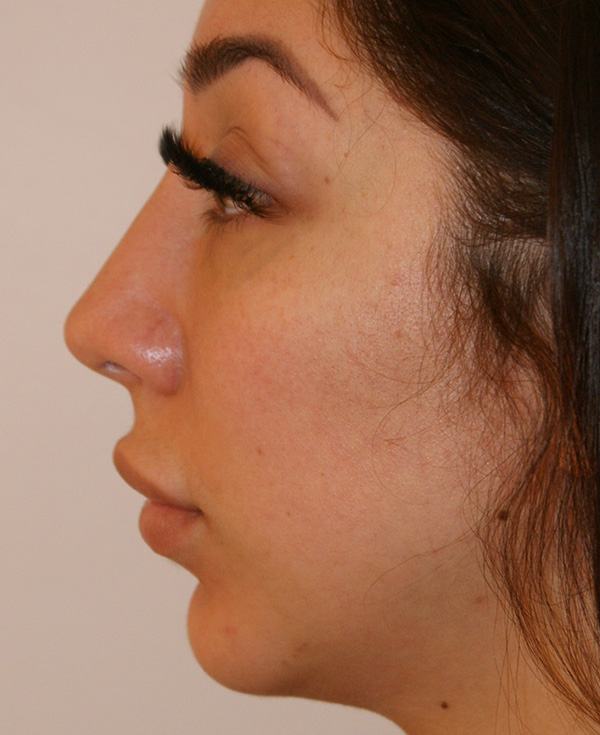 Rhinoplasty before and after - after