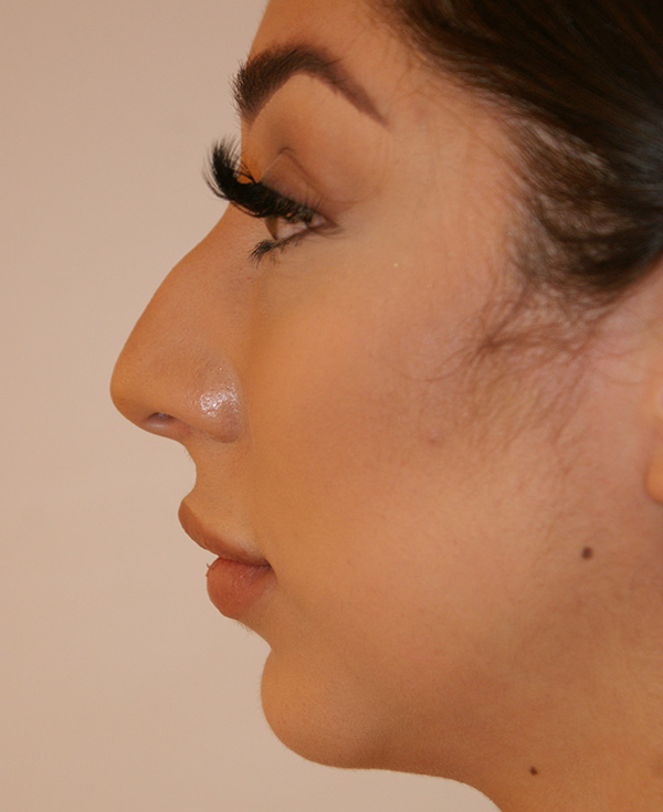 Rhinoplasty before and after - before