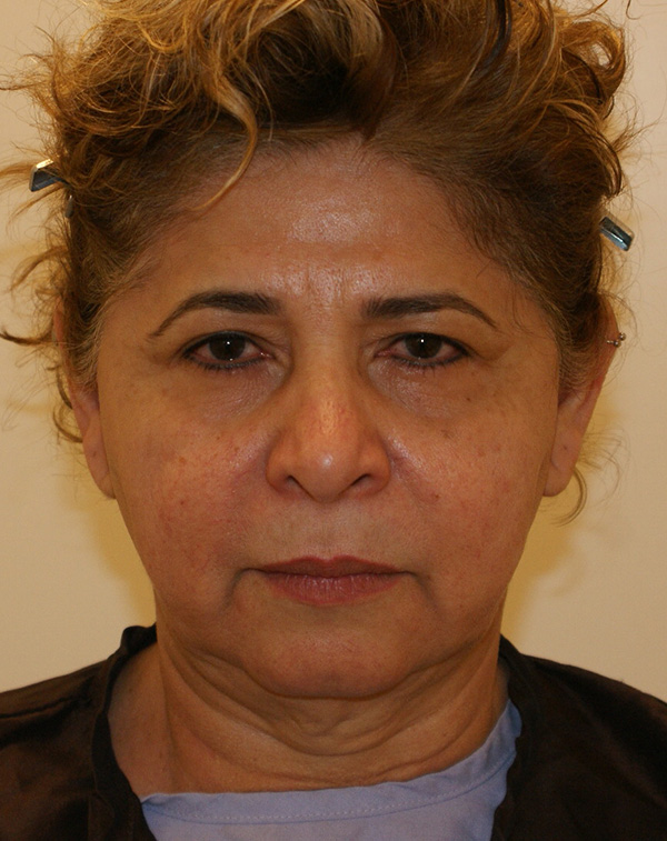 Facial Fat Transfer before and after - before