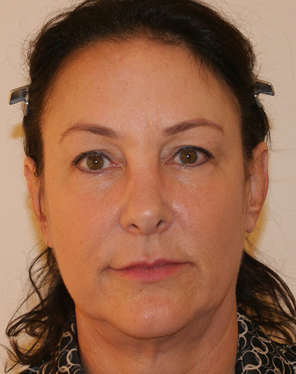 Facial Fat Transfer before and after - before