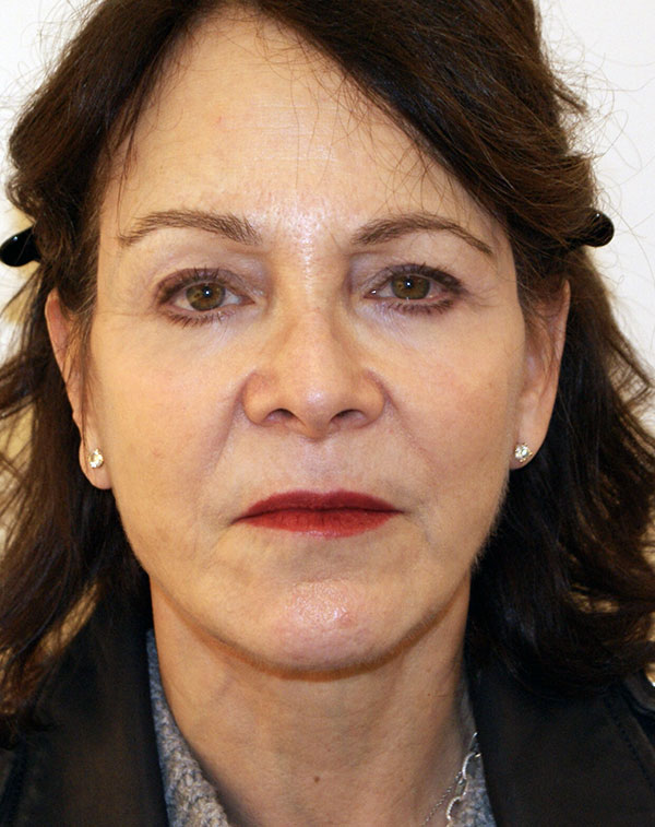 Facial Fat Transfer before and after - after