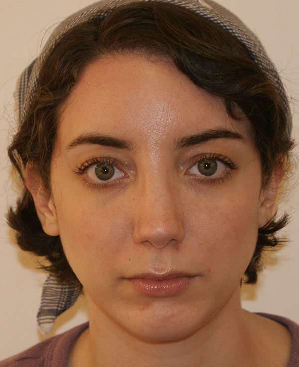 Rhinoplasty before and after - after
