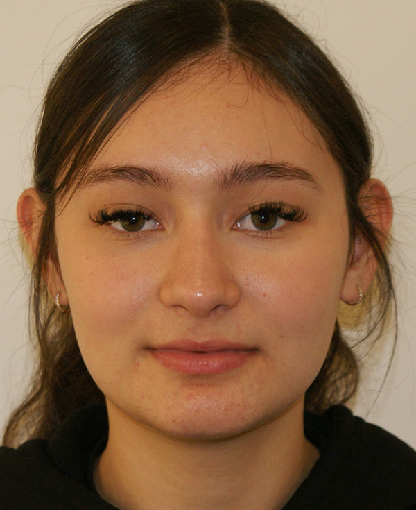 Rhinoplasty before and after - after