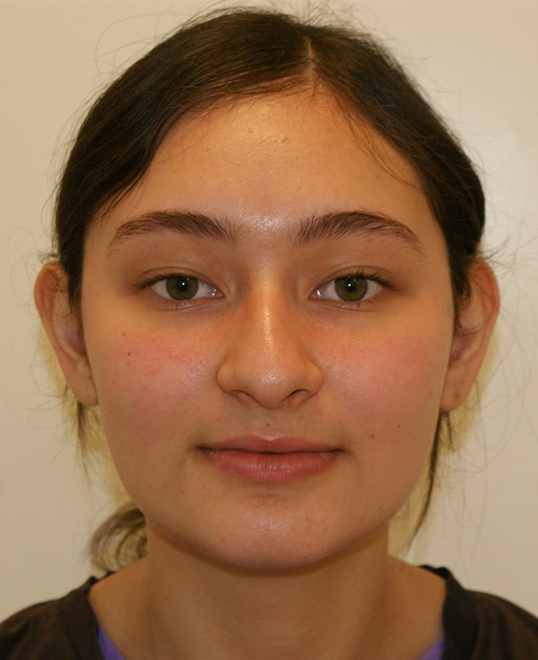 Rhinoplasty before and after - before