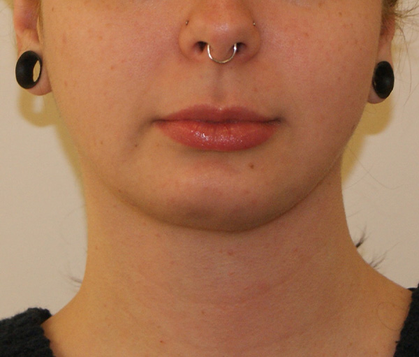 Face and Neck Lift before and after - after