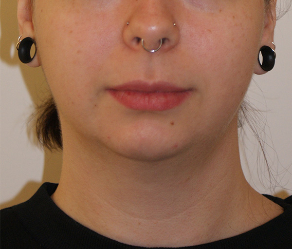 Face and Neck Lift before and after - before