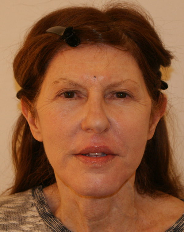 Face and Neck Lift before and after - after