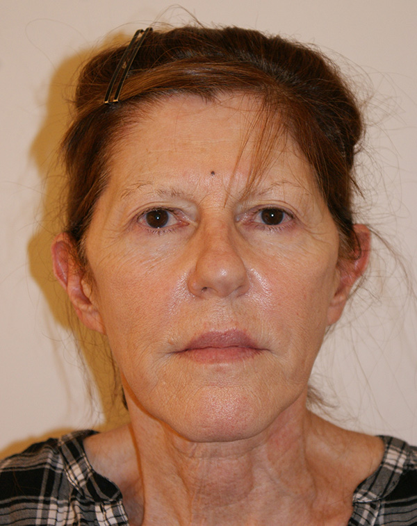 Face and Neck Lift before and after - before