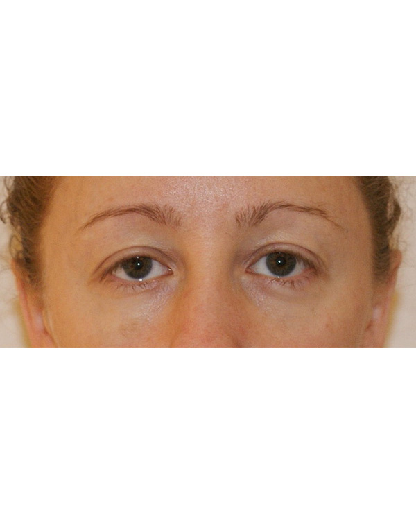 Facial Fat Transfer before and after - after