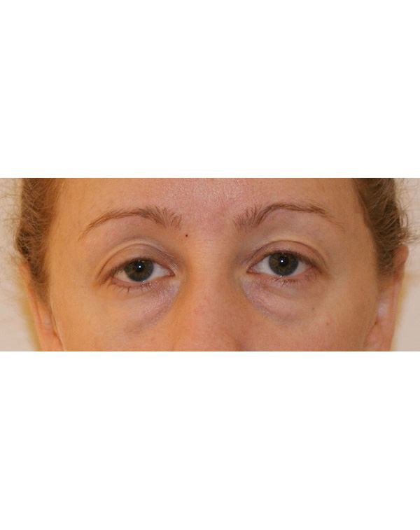 Facial Fat Transfer before and after - before
