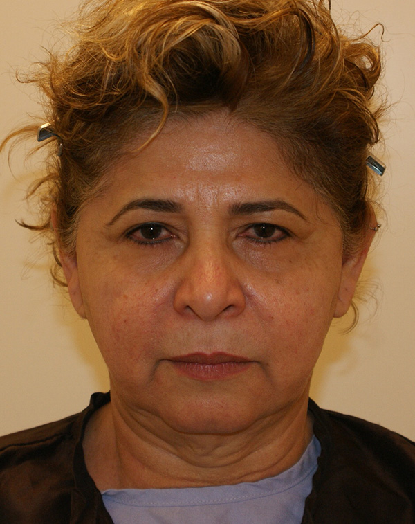 Face and Neck Lift before and after - before