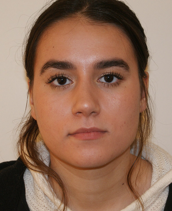 Rhinoplasty before and after - after