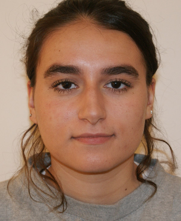 Rhinoplasty before and after - before