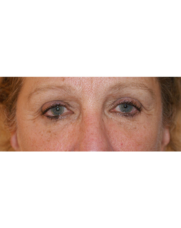 Facial Fat Transfer before and after - after