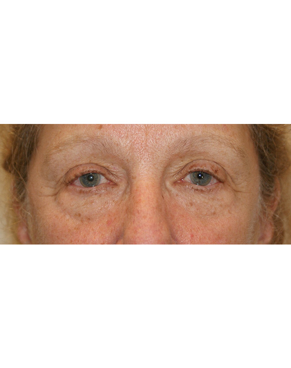 Facial Fat Transfer before and after - before